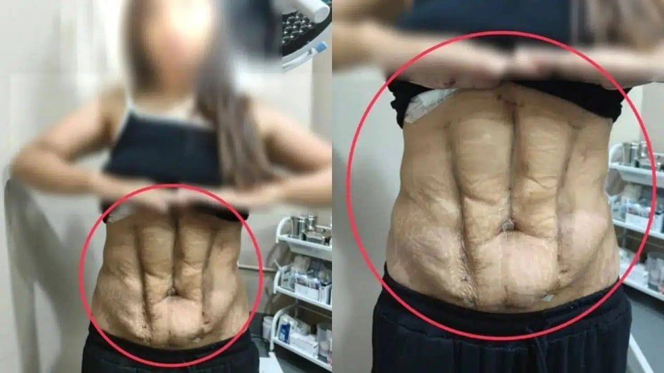 曼谷女子花10万泰铢做“六块腹肌抽脂”,术后腹部变形,诊所称手术效果完美